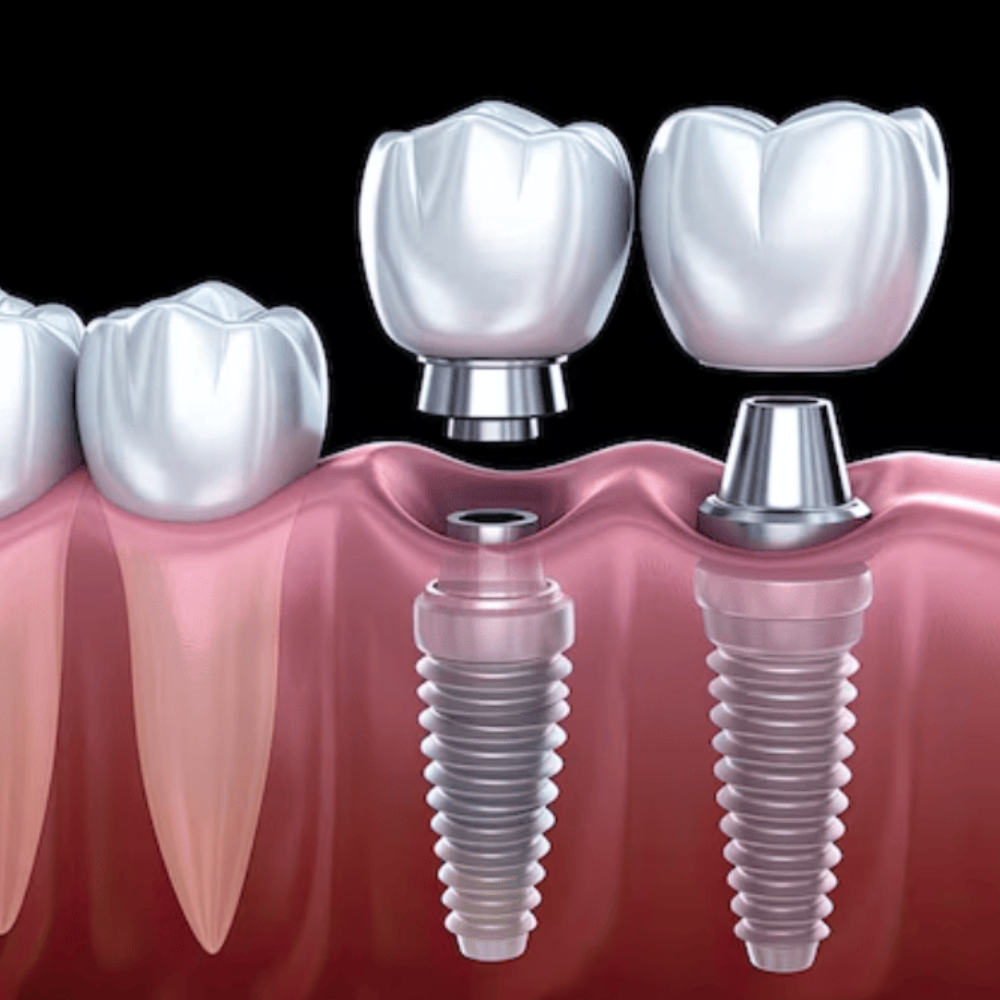 Dental implants