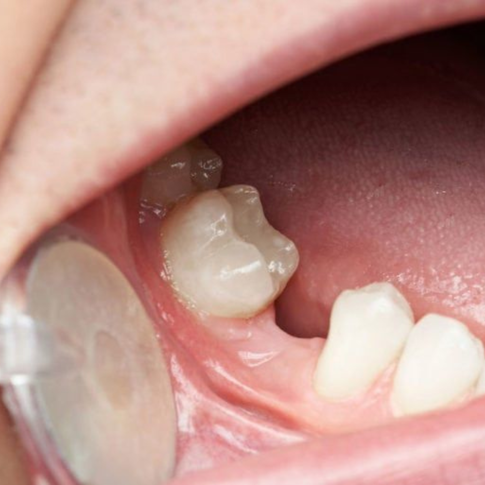 Tooth replacement prosthetics
