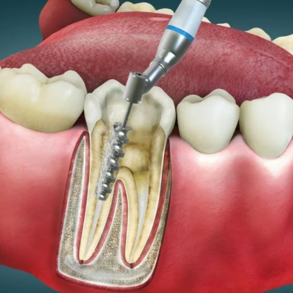 Root canal and fillings