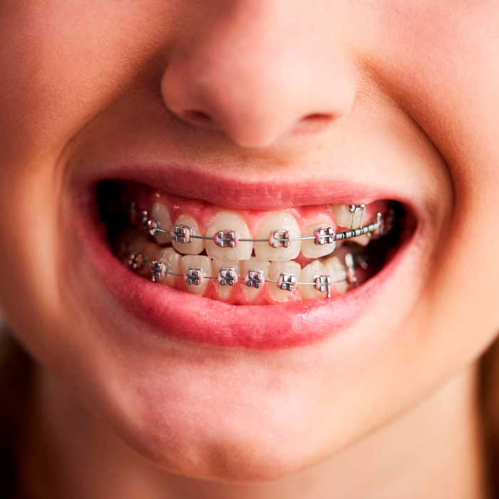 Braces and alignment orthodontics